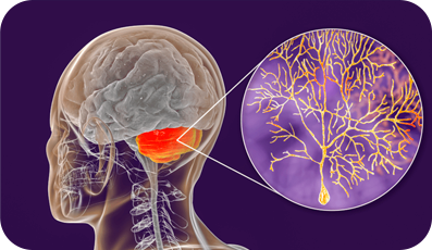 Ataxia cerebelar
