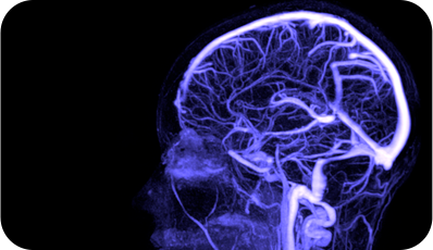 Trombose venosa cerebral